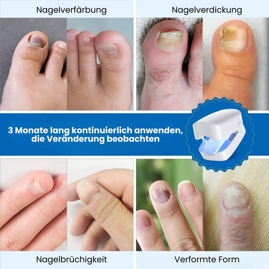 DermaNail - patentierte Nagelpilz-Therapie - für gesunde Nägel innerhalb von 4 Wochen
